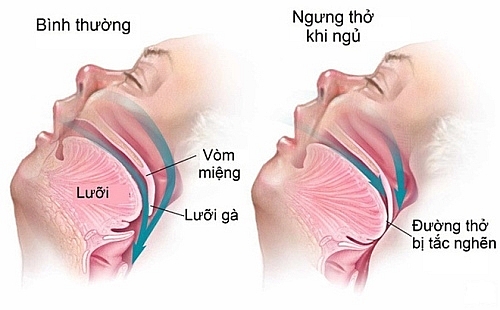 Uống rượu trước khi ngủ và 4 nguy cơ với sức khỏe được chuyên gia cảnh báo