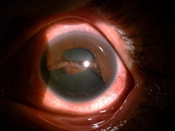 Rửa xe, người đàn ông bị vòi xịt nước trúng mắt, đứt chân mống, đau nhức suốt 4 tháng