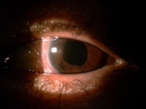 Tình trạng mắt của bệnh nhân sau khi phẫu thuật. Ảnh: BVCC