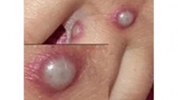 Nhận biết phát ban đậu mùa khỉ