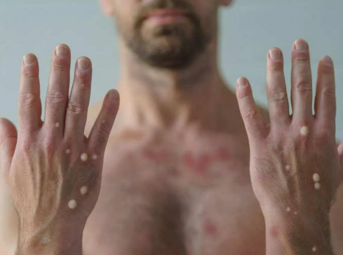 Nhận biết phát ban đậu mùa khỉ