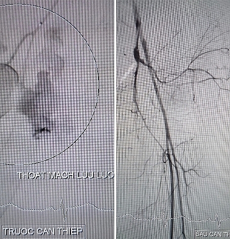 Tường đổ đè lên người, thợ xây nguy kịch