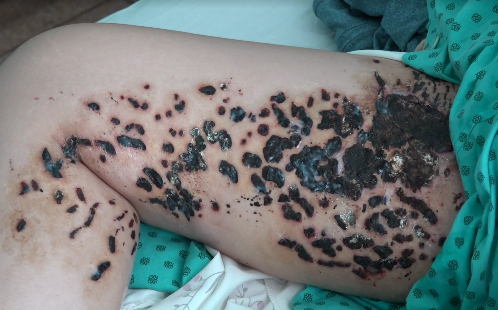 Cô gái 24 tuổi bị nhiễm trùng nặng, không đi được sau điều trị rạn da ở spa