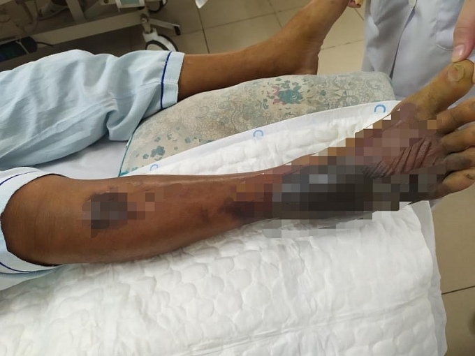 Chân hoại tử, nhiễm khuẩn huyết nguy kịch tính mạng sau khi vệ sinh khu nuôi tôm