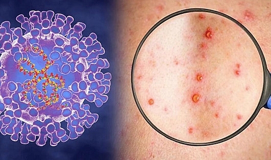 Bình tĩnh, hiểu biết, chủ động phòng ngừa bệnh đậu mùa khỉ