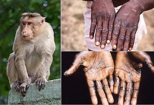 Bình tĩnh, chủ động phòng ngừa bệnh đậu mùa khỉ