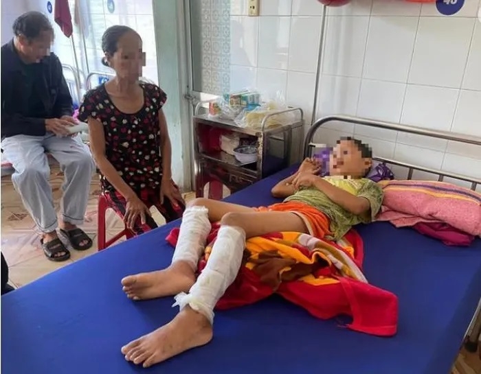 Cháu bé lớp 3 bị bố đốt bỏng 2 chân: Cảnh báo về nạn bạo hành trẻ em