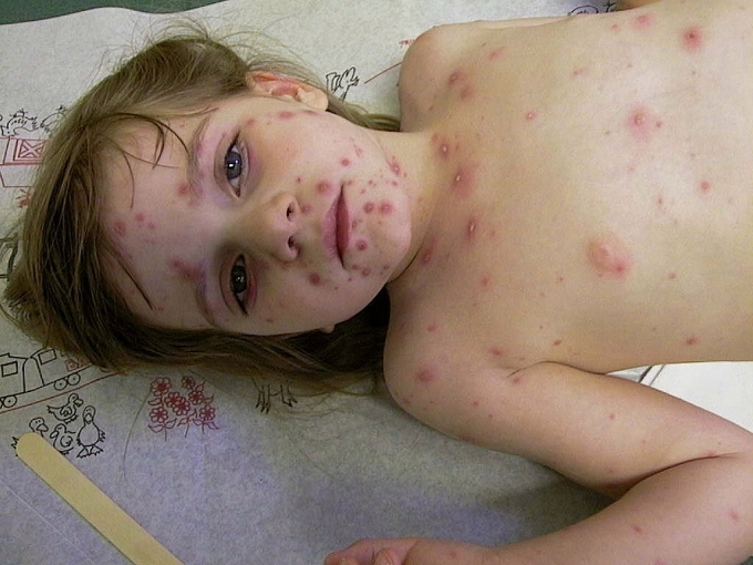 Những đặc điểm giúp phân biệt bệnh đậu mùa khỉ và thủy đậu