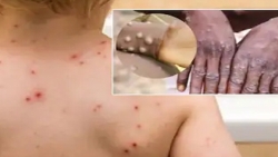 Đậu mùa khỉ, thủy đậu: giống và khác nhau như thế nào?