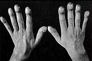 Công nhân mắc bệnh phổi nghề nghiệp được hỗ trợ nhờ Chương trình Bệnh phổi kẽ