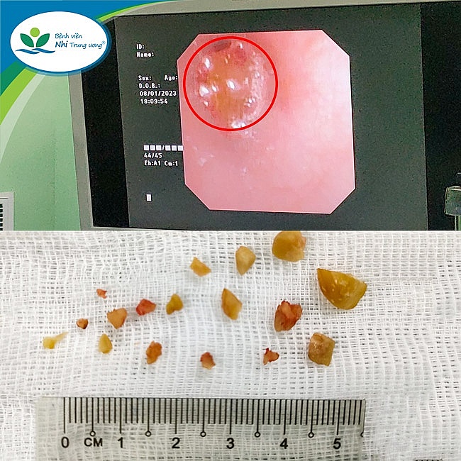 Cảnh báo nguy cơ trẻ hóc dị vật trong ngày Tết