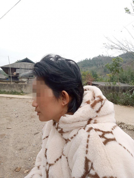 Người bệnh sau 8 tháng được bác sĩ phẫu thuật nối thành công toàn bộ da đầu kèm hai tai và hai mí mắt. Ảnh: NVCC