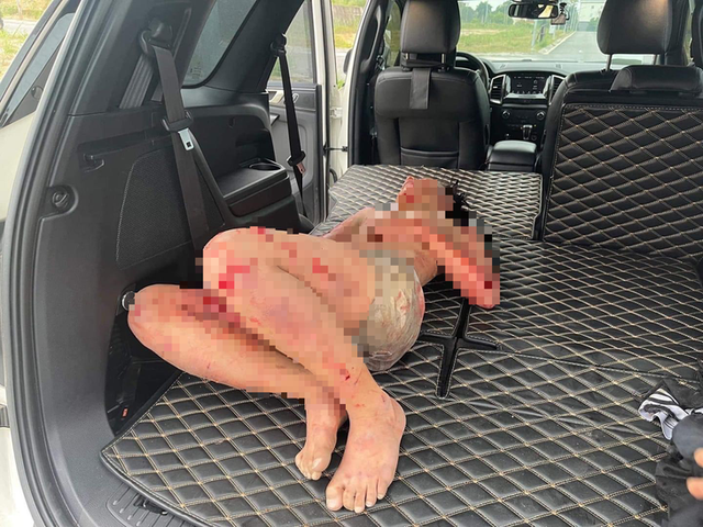 Bác sĩ thông tin về sức khỏe nam sinh bị 2 chó dữ tấn công khi đang đi đường