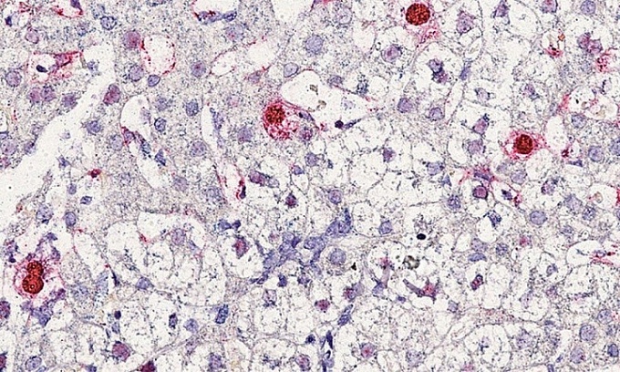 Bất ngờ phát hiện virus mới gây bệnh viêm gan ở người