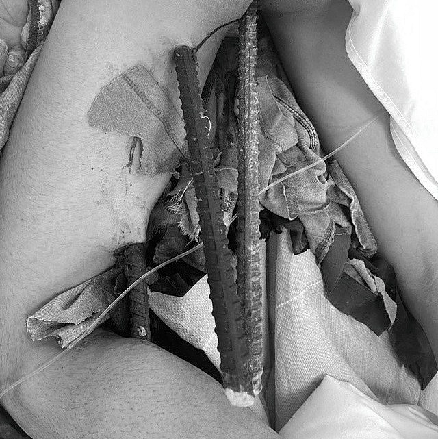 Nam công nhân bị ngã vào 3 cọc sắt khi đang lao động