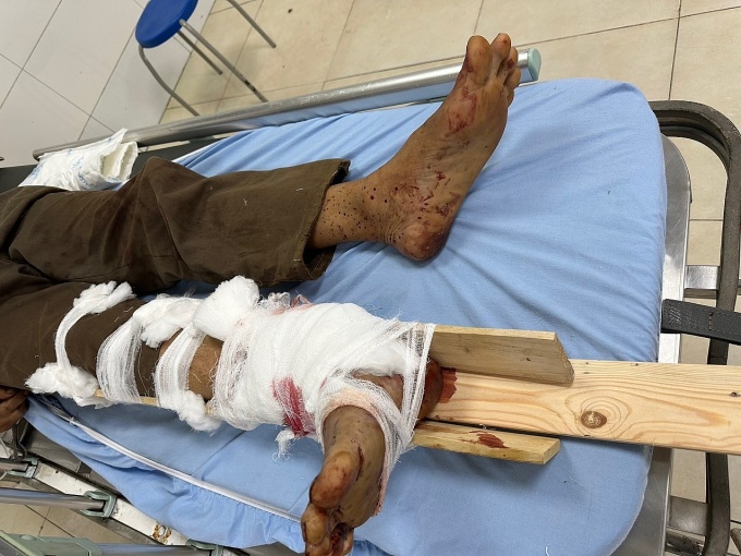 Một lao động bị tai nạn đứt rời cổ chân khi đang cưa cây