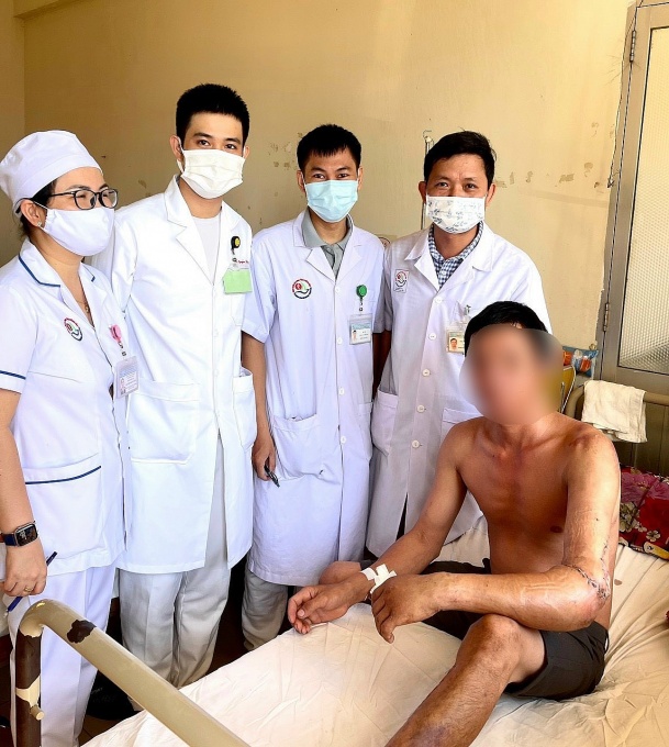 Nối thành công phần tay đứt lìa cho 3 lao động bị tai nạn