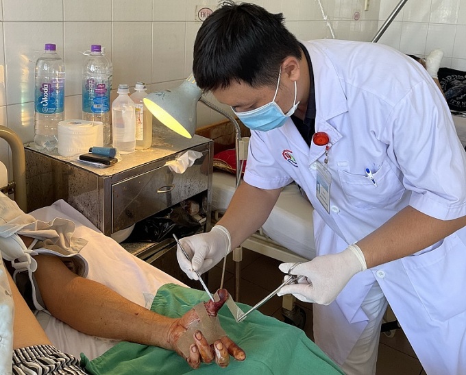 Nối thành công phần tay đứt lìa cho 3 lao động bị tai nạn