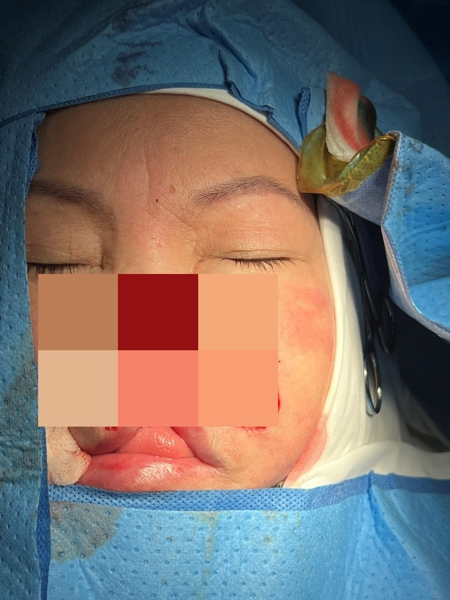 Cẩn trọng ung thư biểu mô tế bào đáy với các nốt trên bề mặt da biểu hiện bất thường