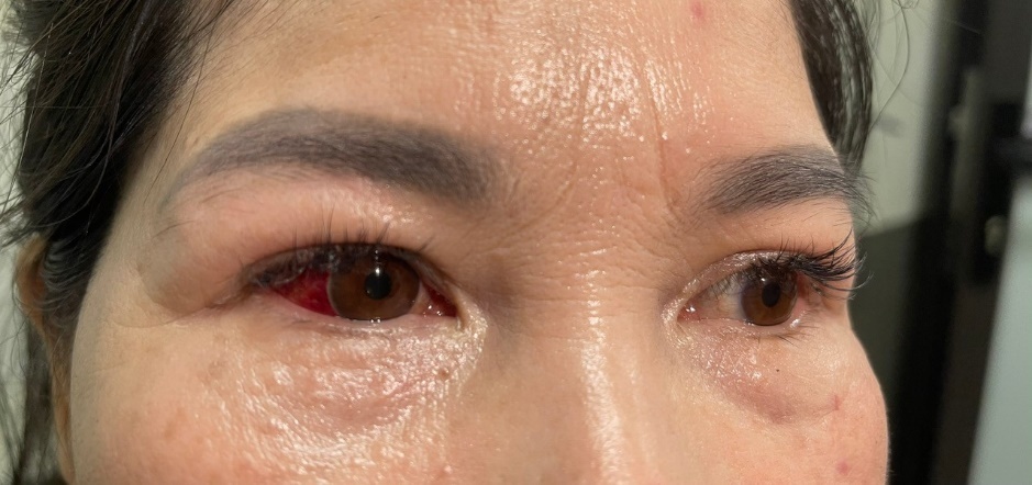 Sau mưa lũ, cần cảnh giác với nguy cơ bùng phát dịch viêm kết mạc