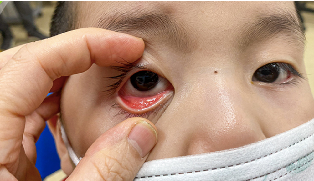 Sau mưa lũ, cần cảnh giác với nguy cơ bùng phát dịch viêm kết mạc