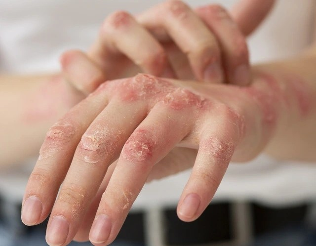 Nguy cơ bệnh về da tăng cao sau bão lũ: chăm sóc, phòng tránh thế nào?