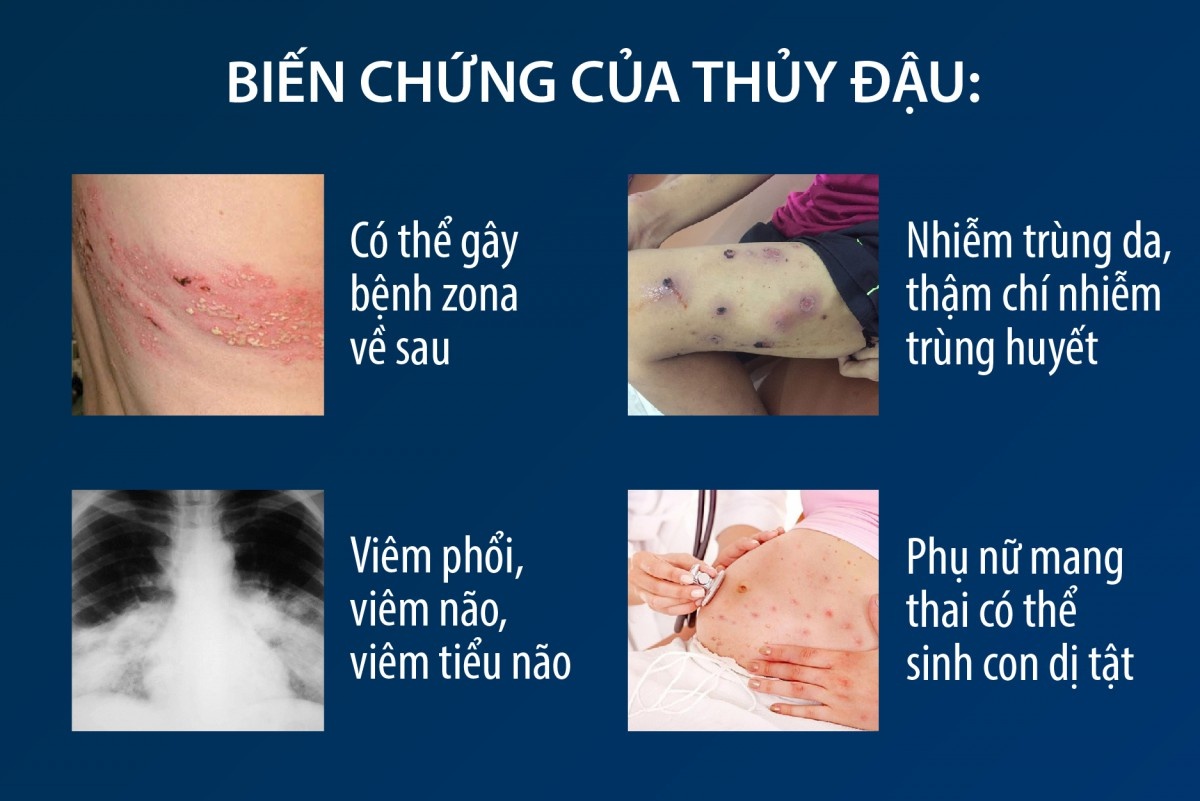 Báo động dịch thủy đậu bùng phát tại khu công nghiệp: Nguy cơ lan rộng và bài toán ý thức phòng dịch