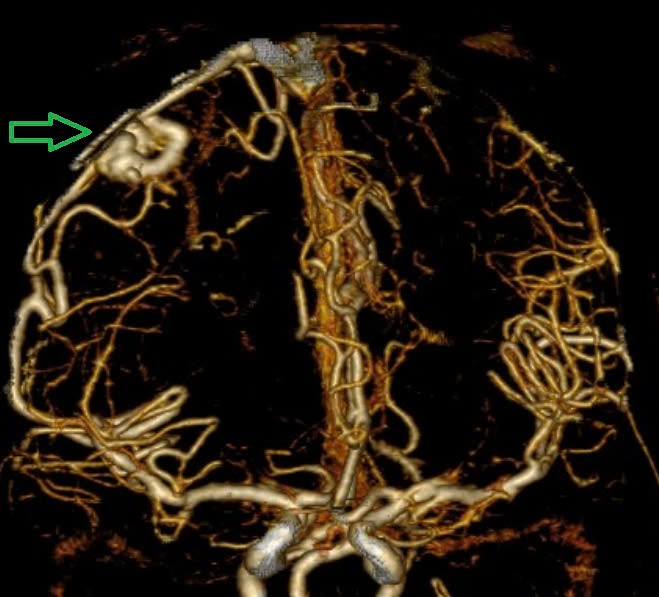 Dị dạng mạch máu não – Kẻ giết người thầm lặng