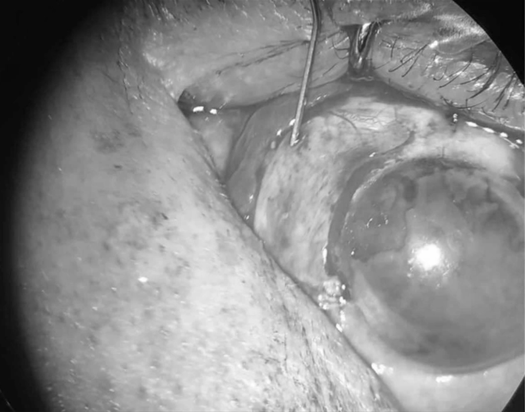 Quảng Bình: Lần đầu ứng dụng keo dán sinh học trong phẫu thuật mắt an toàn