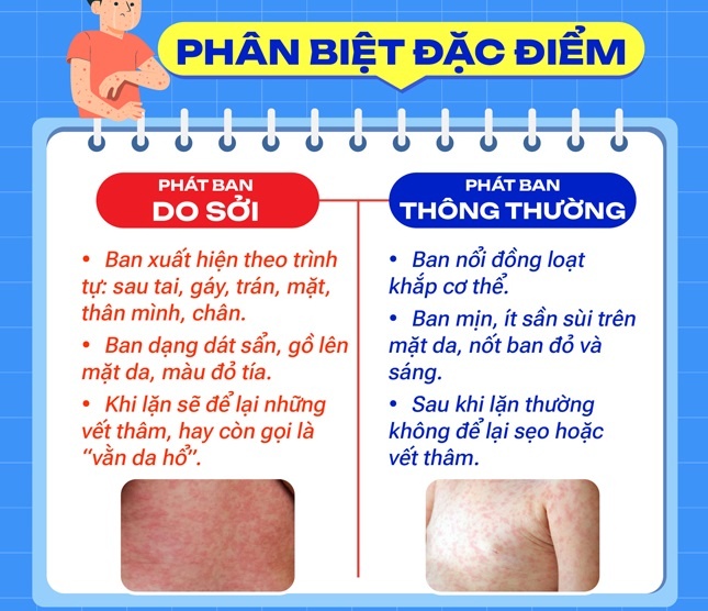 Cách phân biệt phát ban do sởi và phát ban thông thường