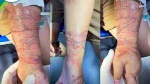 Viêm da tiếp xúc do Sứa biển: Cách nhận biết và sơ cứu đúng cách