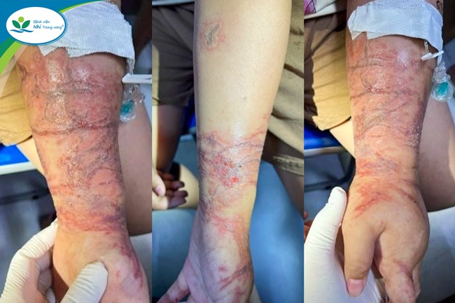 Viêm da tiếp xúc do Sứa biển: Cách nhận biết và sơ cứu đúng cách