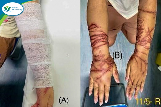 Viêm da tiếp xúc do Sứa biển: Cách nhận biết và sơ cứu đúng cách