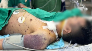 Thủy đậu: Tử thần rình rập ngay cả người trẻ khỏe