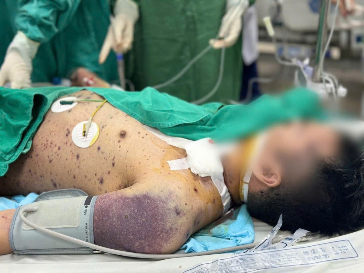 Thủy đậu: Tử thần rình rập ngay cả người trẻ khỏe