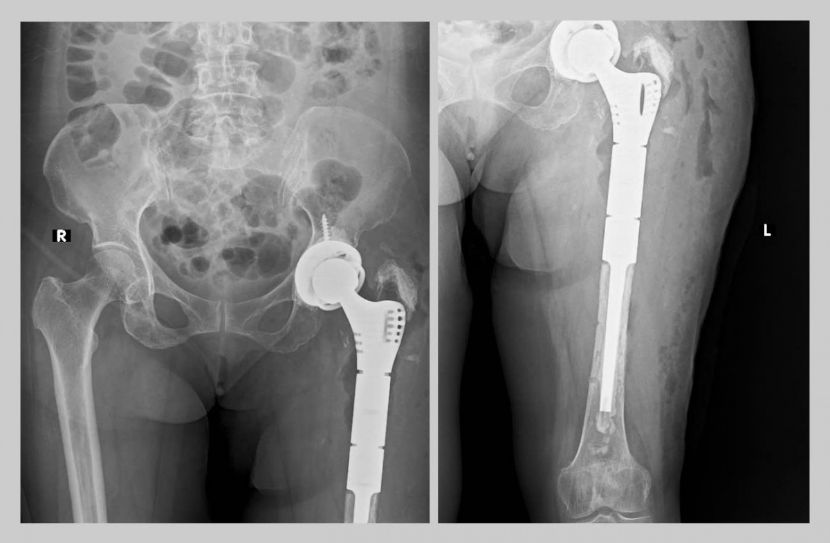 Phẫu thuật thay khớp háng, xương đùi bằng Megaprosthesis thành công đầu tiên ở miền Trung