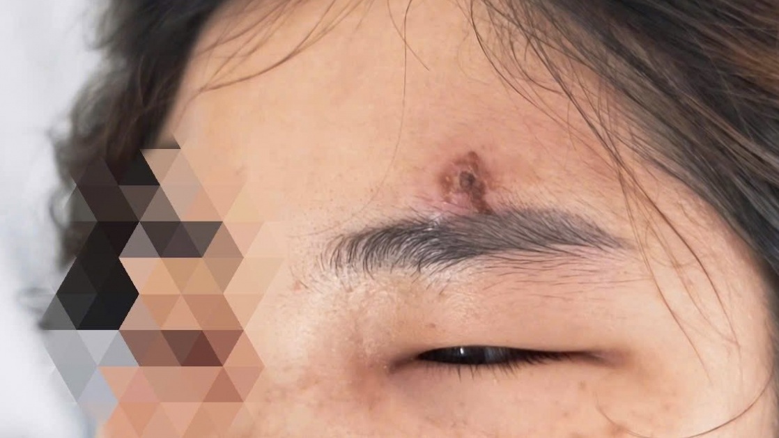 Nặn mụn – Thói quen tưởng vô hại nhưng có thể gây hậu quả nghiêm trọng