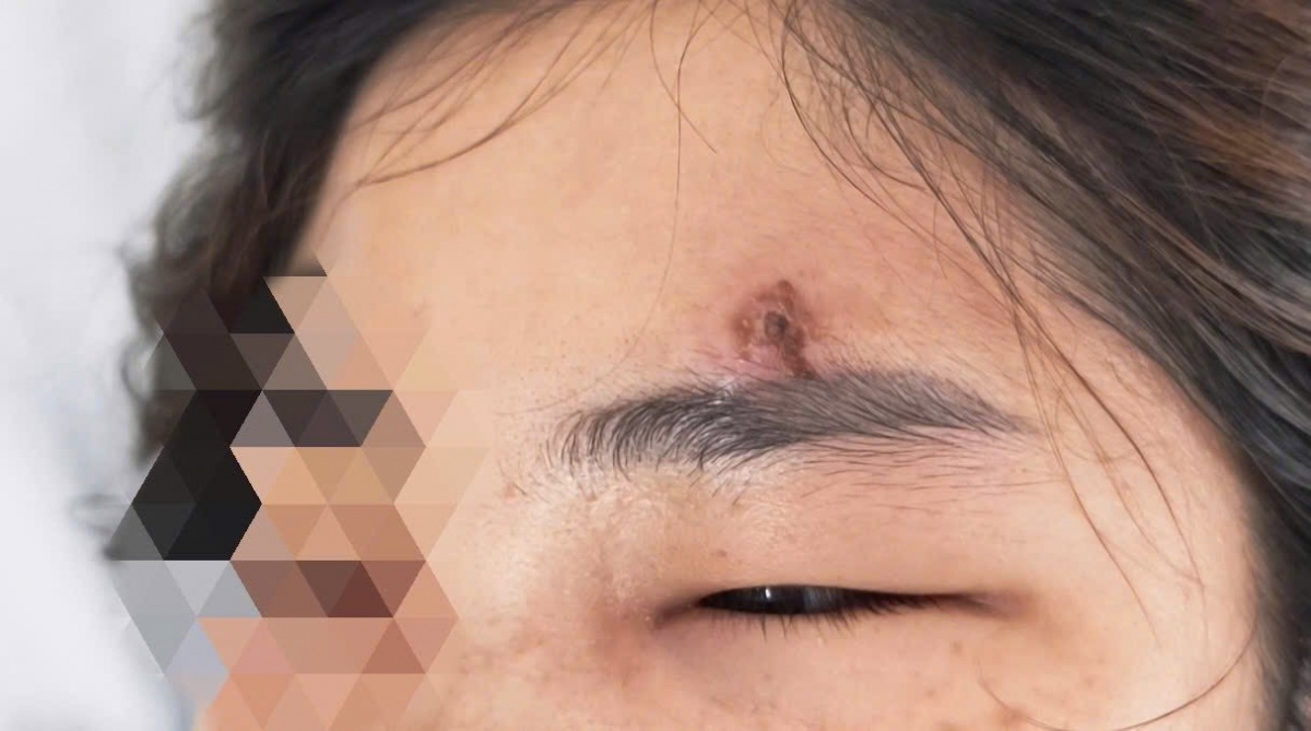 Nặn mụn – Thói quen tưởng vô hại nhưng có thể gây hậu quả nghiêm trọng