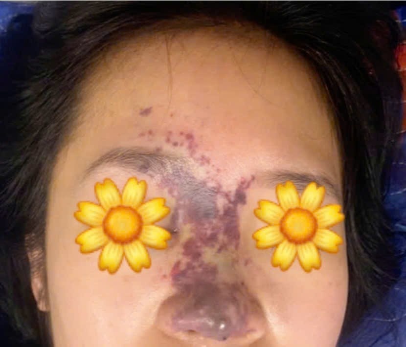 Đặt niềm tin sai chỗ, gánh chịu biến chứng nghiêm trọng khi thẩm mỹ tại spa