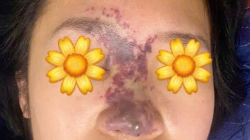 Đặt niềm tin sai chỗ, gánh chịu biến chứng nghiêm trọng khi thẩm mỹ tại spa