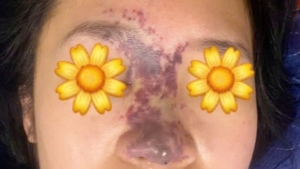 Đặt niềm tin sai chỗ, gánh chịu biến chứng nghiêm trọng khi thẩm mỹ tại spa