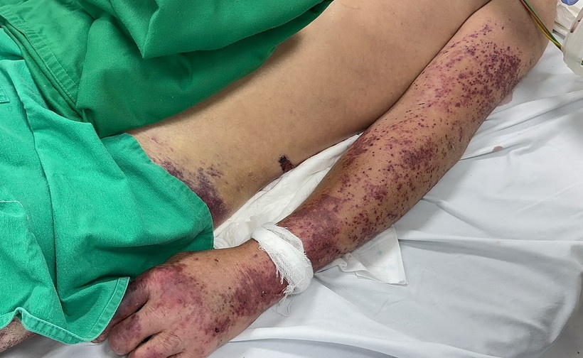 Tử vong do mắc liên cầu lợn ở Huế, ngành Y tế khuyến cáo khẩn